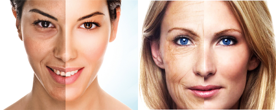 hialuronsko polnilo prej in potem