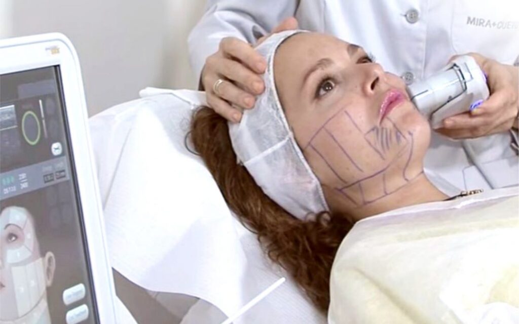 hifu terapija - poseg