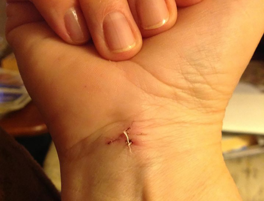 karpalni kanal artroskopski poseg