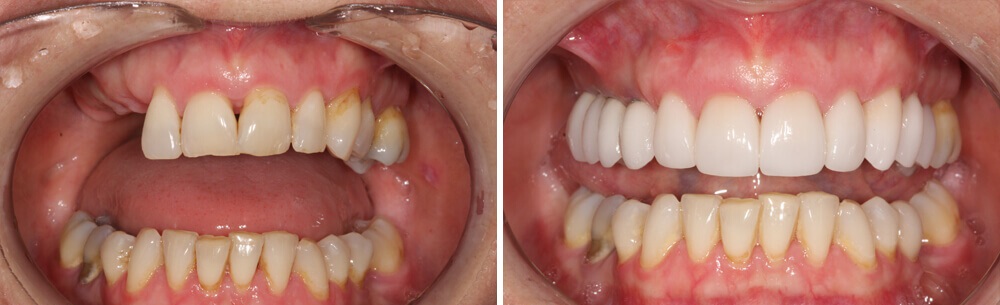 zobni implantat ali vsadek mostiček