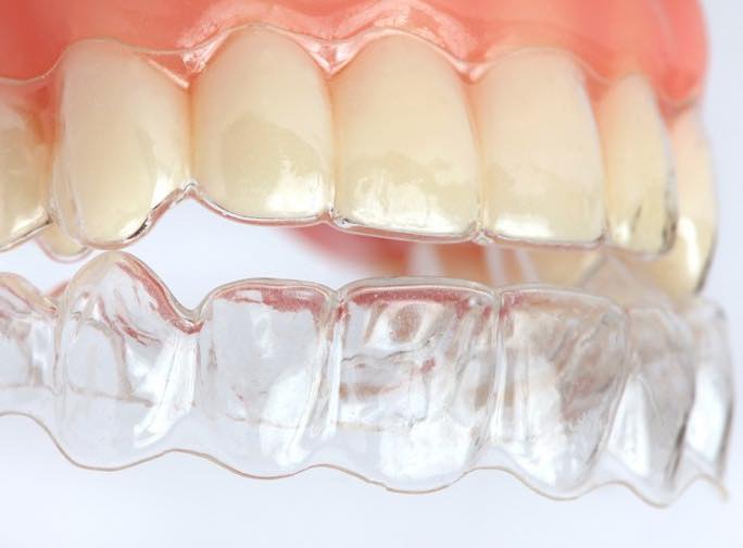 Invisalign zobni aparat