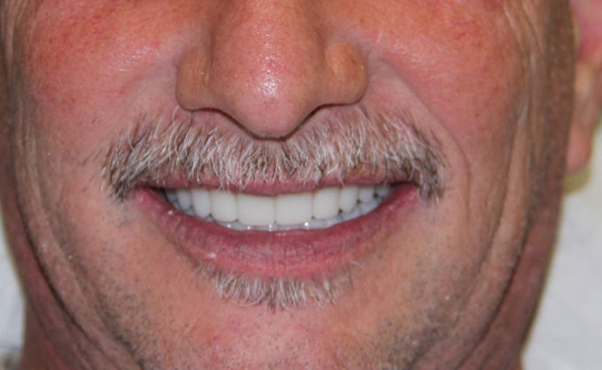 zobna proteza na implantatih pacient 1